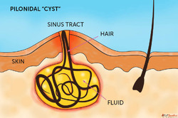 Homeopathy Treatment for Pilonidal Sinus Fidicus Pilonidal