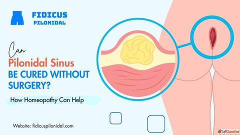 Can Pilonidal Sinus Be Cured Without Surgery How Homeopathy Can Help