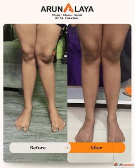 Knock Knee Treatment in Delhi - Non-Surgical Physiotherapy Care