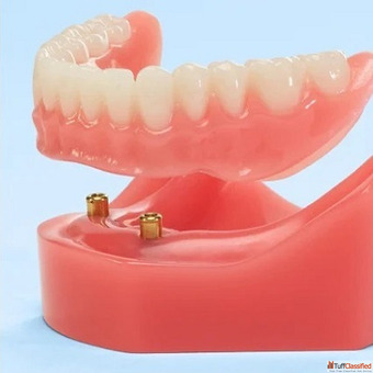 Dental Implants in Dubai