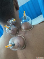 Cupping therapy in Gomti Nagar