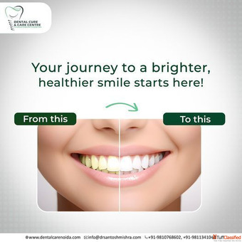 Personalized Dental Care in Noida Sector 79
