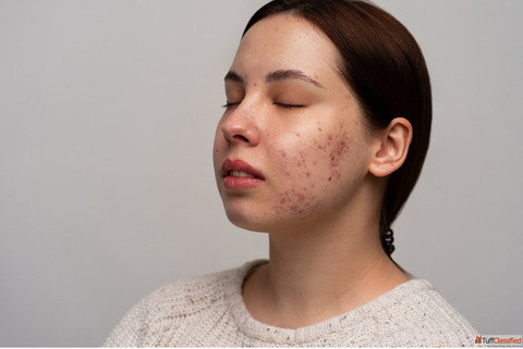 Healing Pimple Scars with Patience and Gentle Care