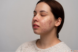 Healing Pimple Scars with Patience and Gentle Care