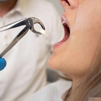 Cheap Tooth Removal Near Me
