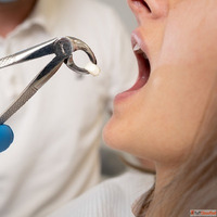 Cheap Tooth Removal Near Me