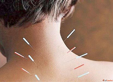 Dry needling in Gomti Nagar