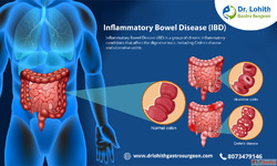 Best Treatment for Inflammatory Bowel Disease in Sarjapur Ro...