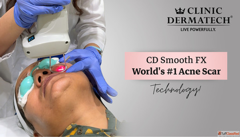 CD Smooth FX - Advanced Acne Scar Treatment at CD Lush Delhi
