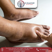 Improve Healing Mobility with Best Diabetic Foot Treatment i...