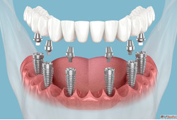 Smile Confidently Again with Custom Dental Implants