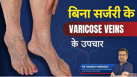 Minimally Invasive Varicose Veins Treatment in Mumbai India - Dr. Dharav Kheradia