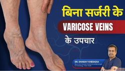 Minimally Invasive Varicose Veins Treatment in Mumbai India ...