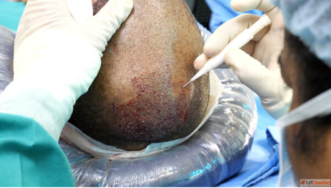 PRP Treatment for Hair Skin at Dermavue Thrissur
