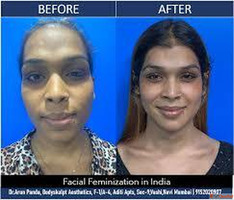 Trusted FFS Specialist - Dr. Arun Panda Mumbai