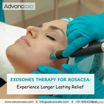 Exosomes Therapy for Rosacea Exosomes Rosacea