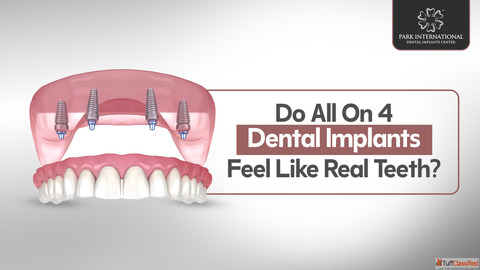 Best Dental Implants Center in Hyderabad India Park International Dental Implants Center