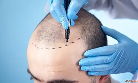 Best Hair Transplant Clinic in Mumbai for Natural-Looking Results