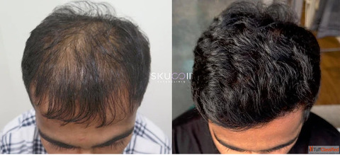 Best Hair Transplant Clinic in Mumbai for Natural-Looking Results