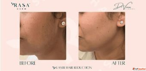 Laser Hair Removal in Delhi Rasaderm