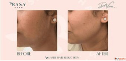 Laser Hair Removal in Delhi Rasaderm
