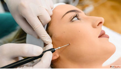 Top Mole Removal Treatment Options Laser Surgery and More