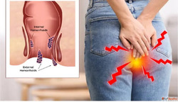 Best Homeopathy Doctor for Piles in Noida - Safe Natural Car...