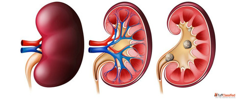 Kidney Stone Relief with Trusted Homeopathy Doctor in Noida