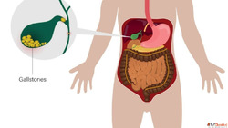 Expert Homeopathic Treatment for Gallbladder Stone in Noida