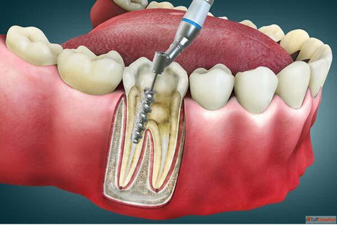 Affordable Lasting Dental Implants in Goa