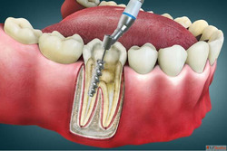 Affordable Lasting Dental Implants in Goa