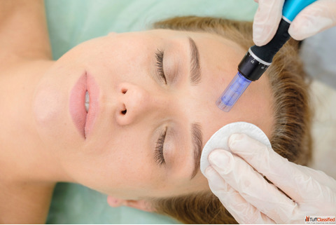 Microneedling in Kingston Ontario for Treatment of Acne Scars