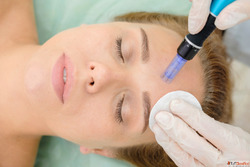 Microneedling in Kingston Ontario for Treatment of Acne Scar...