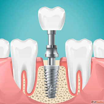 Best Dental Hospital in Sainikpur Secunderabad - LADS Dental Care