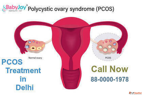 Advanced PCOS Treatment in Delhi - Best Doctors Fertility Care