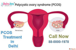 Advanced PCOS Treatment in Delhi - Best Doctors Fertility Ca...