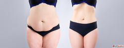 Tummy Tuck Surgery cost in Delhi - Dr Rajat Gupta