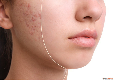 Acne Scar Treatment - Smooth Clear Skin Restored