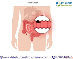 Best Laparoscopic Colon Cancer Surgery in Bangalore - Dr. Lo...