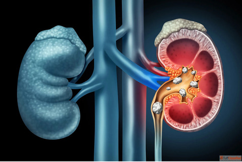 Homeopathic Treatment Medicine for Kidney Stone Dr. Ankur Prakash
