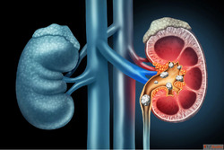 Homeopathic Treatment Medicine for Kidney Stone Dr. Ankur Pr...
