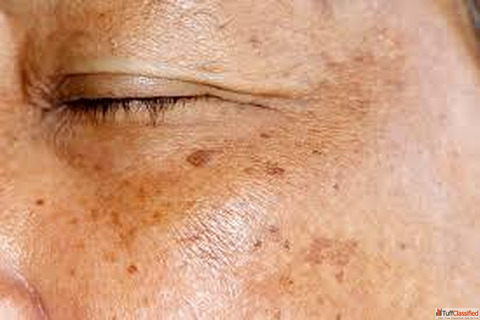 Homeopathic Doctors For Skin Pigmentation in Agra Dr. Ankur Prakash