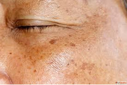 Homeopathic Doctors For Skin Pigmentation in Agra Dr. Ankur ...