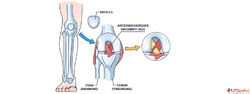ACL Knee Ligament Surgery in Ahmedabad Expert Care