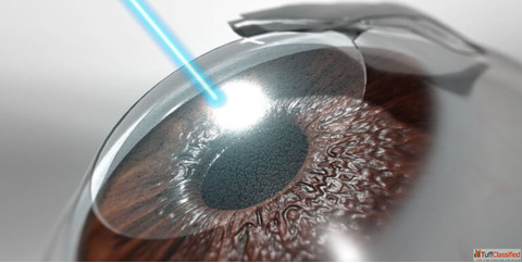 Refractive Surgery in Delhi Say Goodbye to Glasses at Mahajan Eye Centre