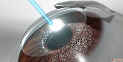 Refractive Surgery in Delhi Say Goodbye to Glasses at Mahaja...