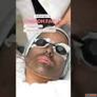 Laser Carbon Peel Treatment Rasaderm