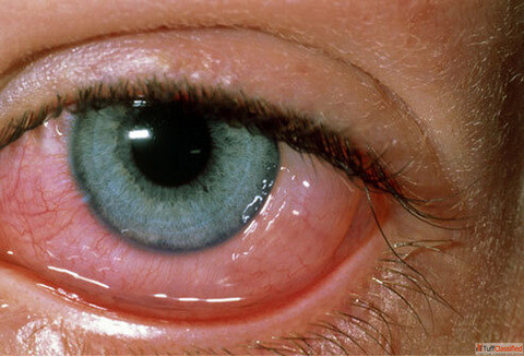 Relieve Eye Redness with Homeopathic Treatment for Conjunctivitis