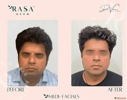 Carbon Facial Rasaderm