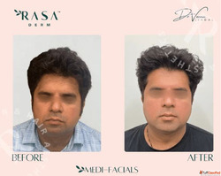 Carbon Facial Rasaderm